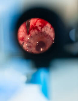 Closeup of corneal surgery at the eye clinic in Hannover — Medical Corporate Photography